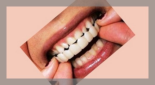 مزیت لمینت متحرک دندان چیست