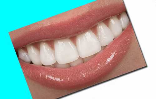 روشهای زیبایی دندان چیست ایا لمینت ها با هم متفاوت هستند